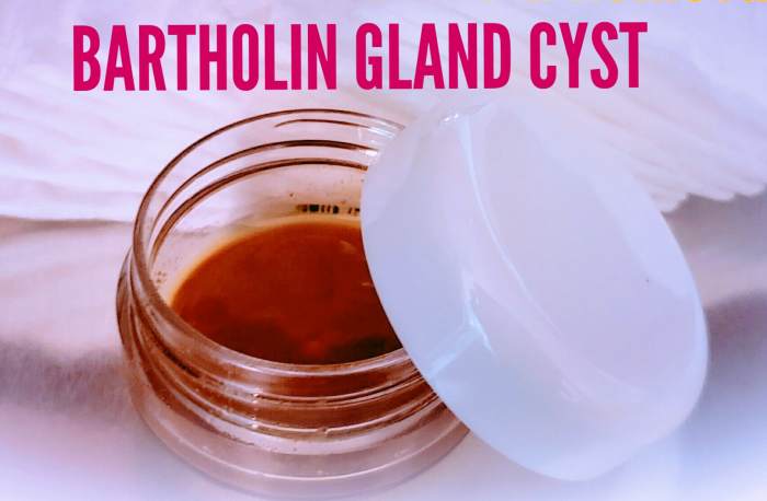 Can i swim with a bartholin cyst