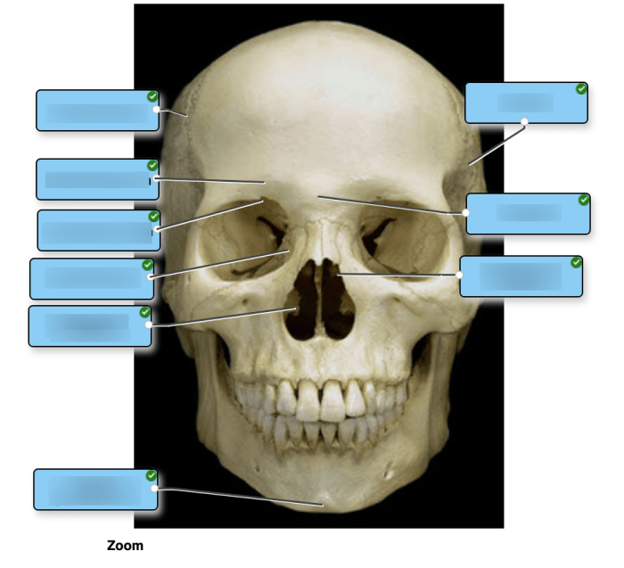 Label the specific bony features of the superior skull.